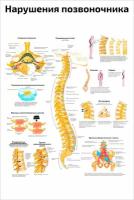 Плакат Квинг Нарушения позвоночника ламинированный 457×610 мм ≈ (А2)
