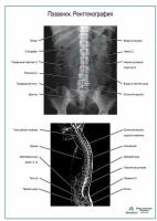 Позвонок. Рентгенография плакат, глянцевая фотобумага от 200 г/кв.м, размер A2+