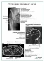 Рентгенография тазобедренного сустава, плакат, глянцевая фотобумага от 200 г/кв.м, размер A1+