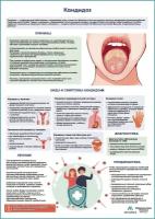Кандидоз медицинский плакат, матовый холст от 200 г/кв. м, размер A1+
