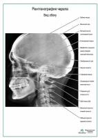Рентгенография черепа. Вид сбоку плакат, глянцевая фотобумага от 200 г/кв.м, размер A2+