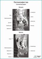 Рентгенография таза, плакат, глянцевая фотобумага от 200 г/кв. м, размер A1+