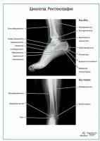 Щиколотка. Рентгенография, плакат, глянцевая фотобумага от 200 г/кв. м, размер A2+