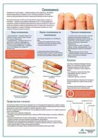 Онихомикоз медицинский плакат глянцевая фотобумага от 200 г/кв.м, размер A2+